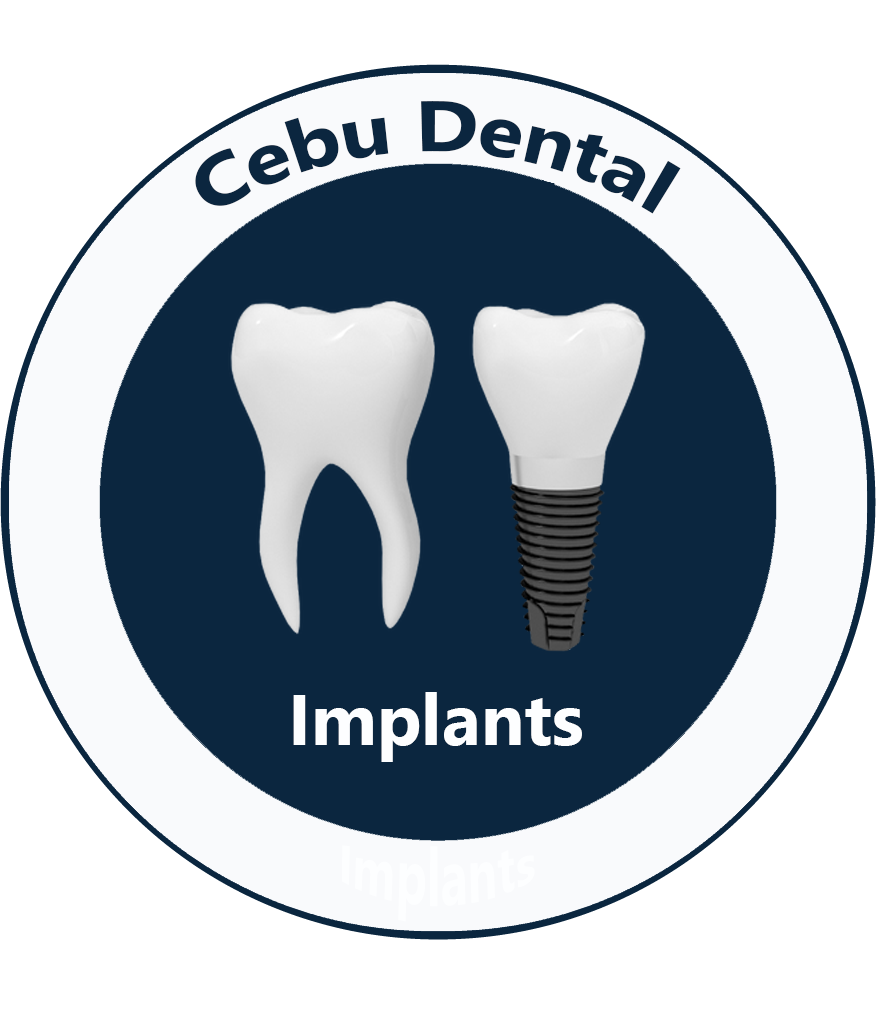 Cebu Dental Implants