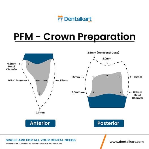 PFM Crown Preparation Step by Step Standard Protocol For Perfect Fit 