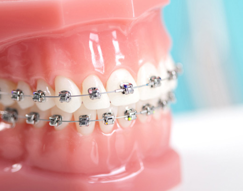 cebu dental braces