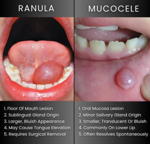 Ranula Cebu Dental Implants Ranula Cebu Dental Implants